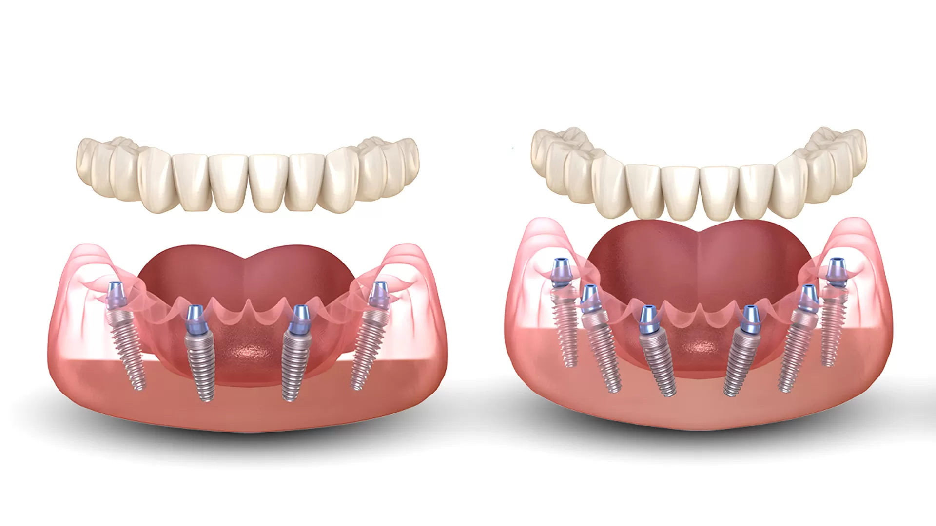 implant all-on-6 giá - hình 3