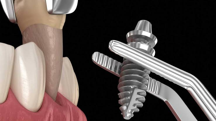Implant tức thì là gì: cấy trụ ngay sau khi nhổ răng 2026