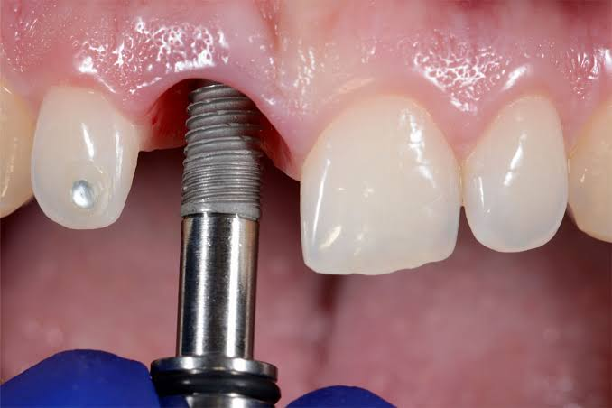 implant tức thì - hình 2