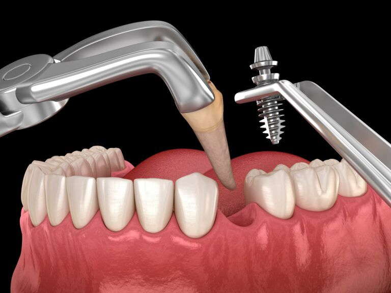 implant tức thì - hình 3