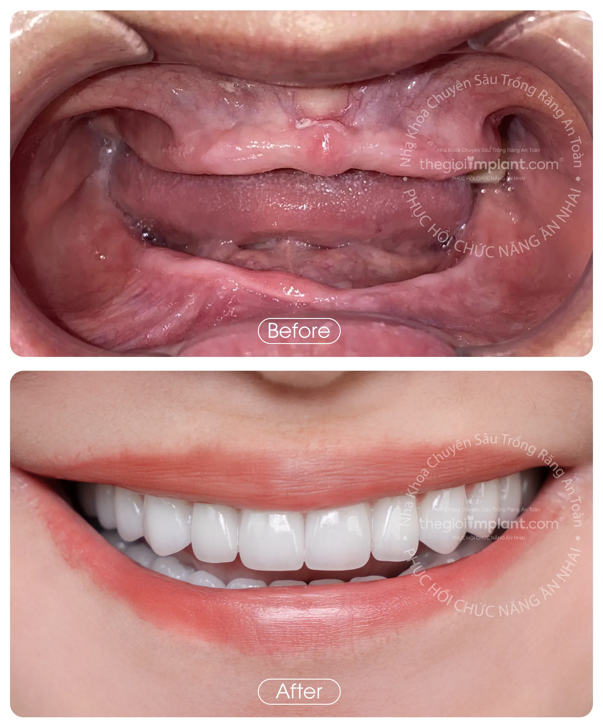 Thế Giới Implant Homepage v3