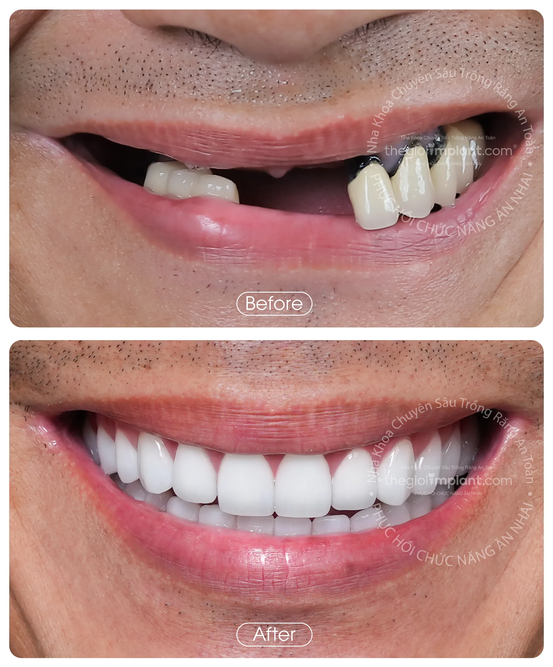 Thế Giới Implant Homepage v3