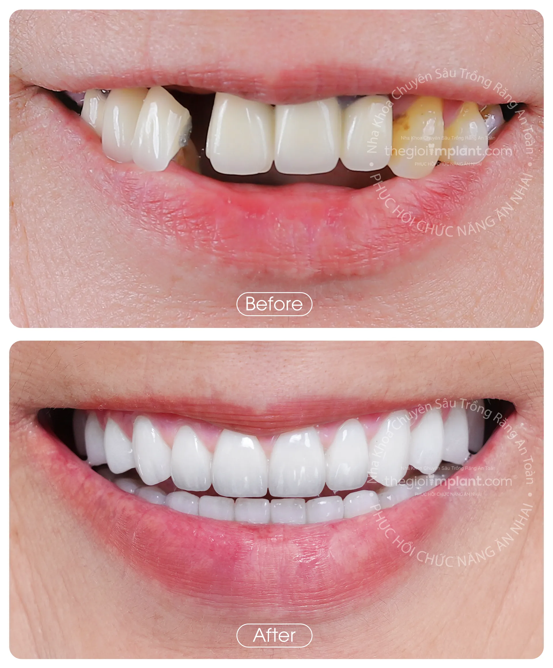 Thế Giới Implant Homepage v3