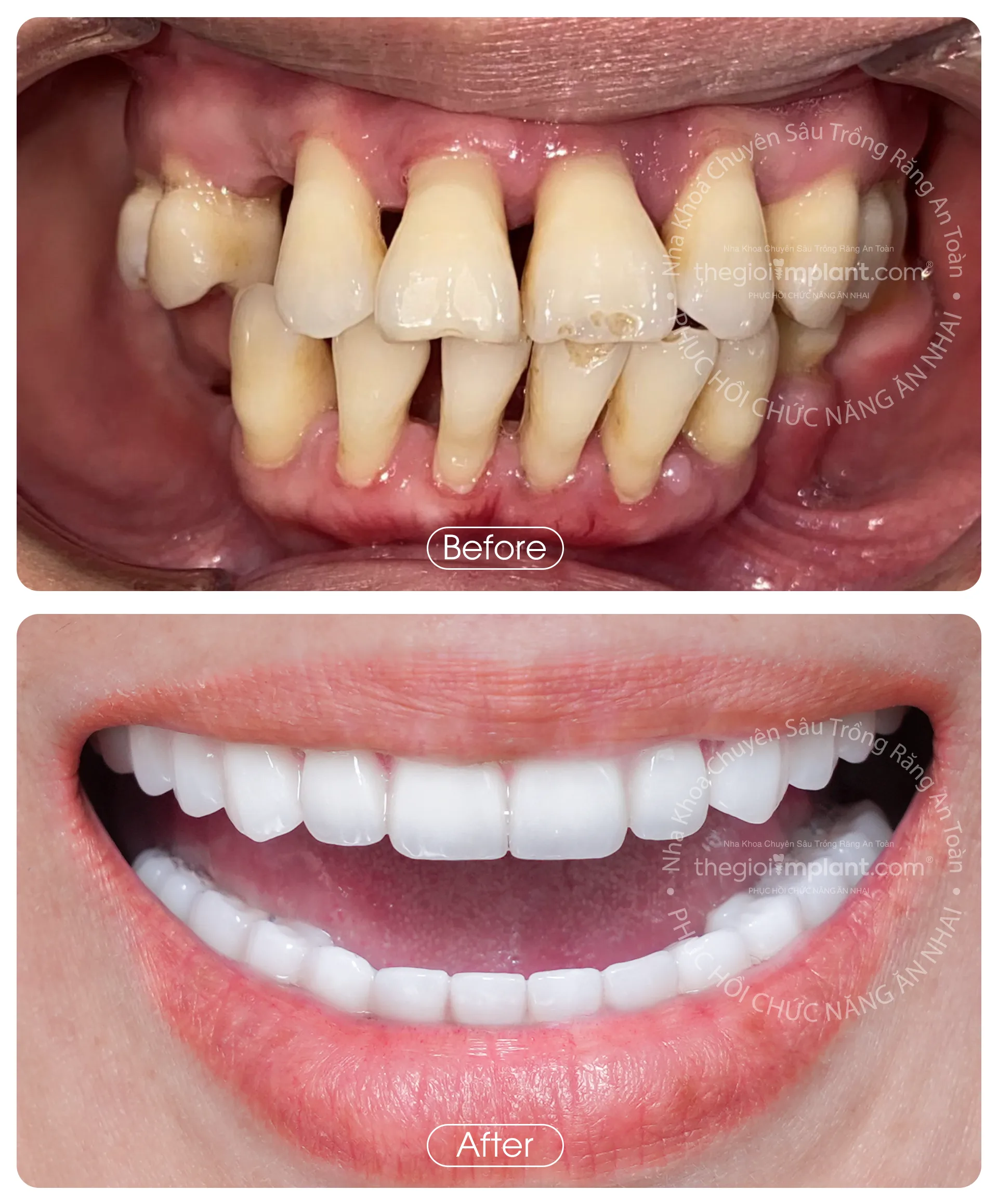 Thế Giới Implant Homepage v3