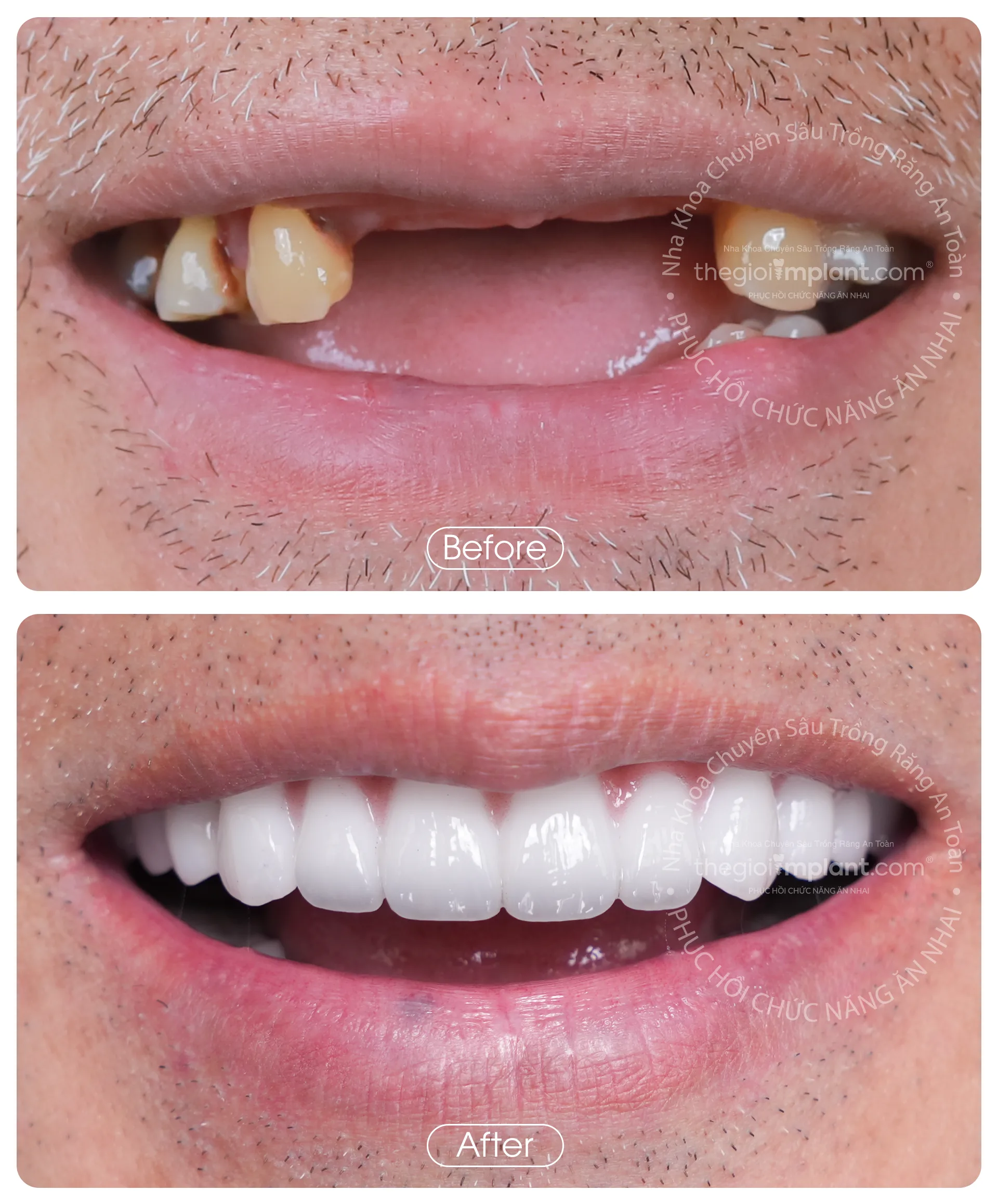 Thế Giới Implant Homepage v3