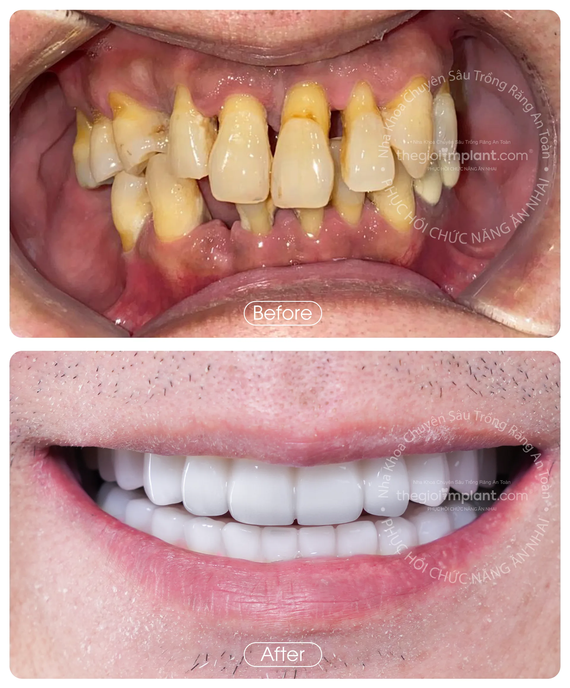 Thế Giới Implant Homepage v3