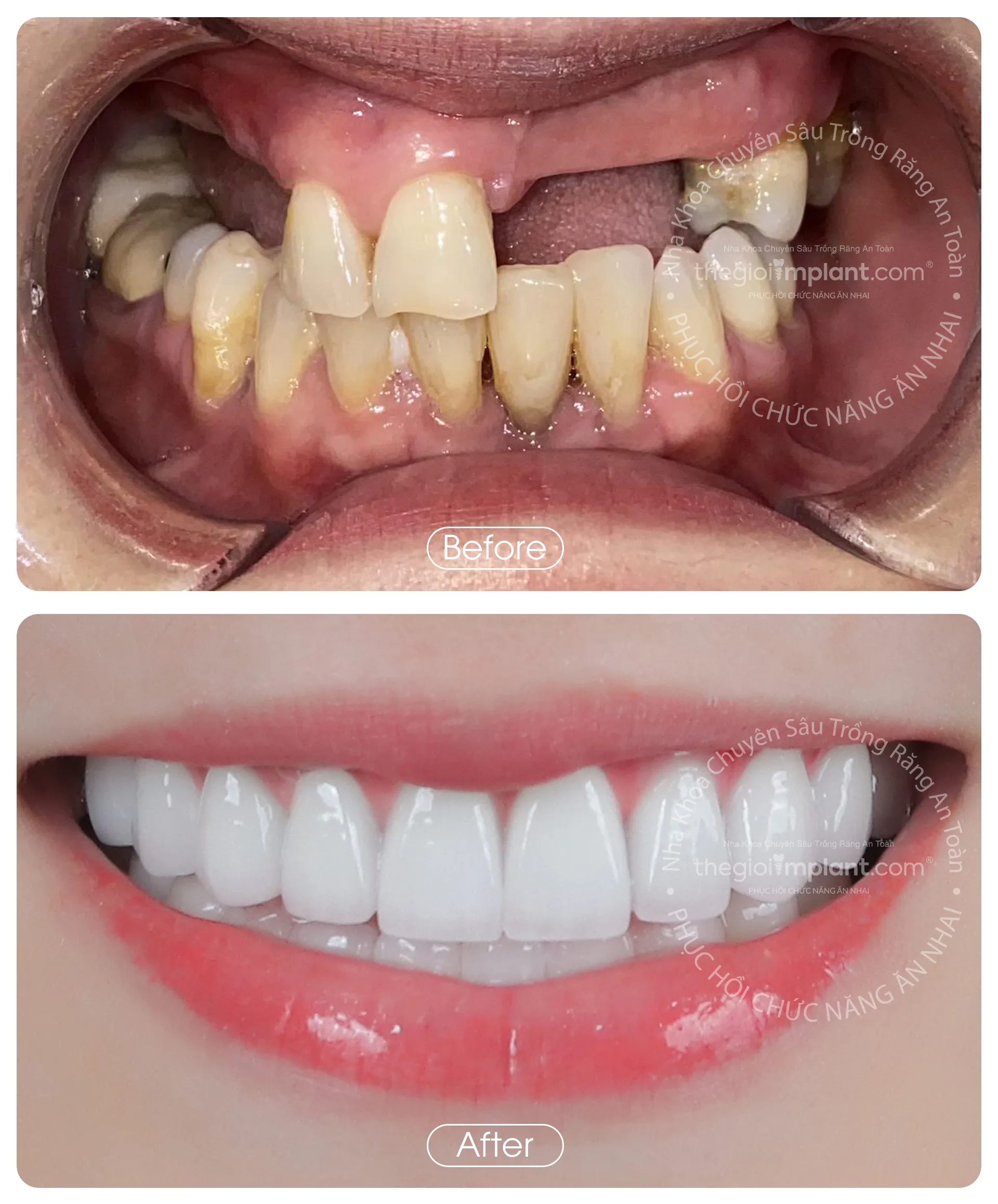 Thế Giới Implant Homepage v3