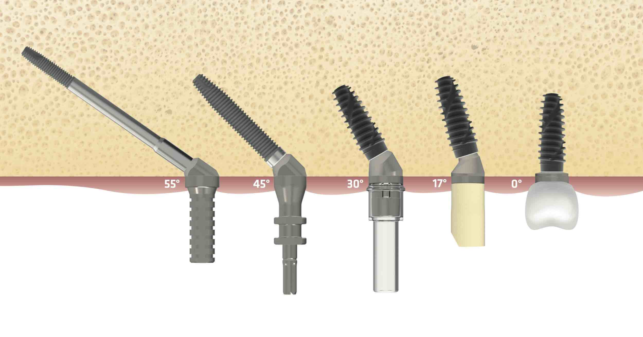 implant btk - hình 2