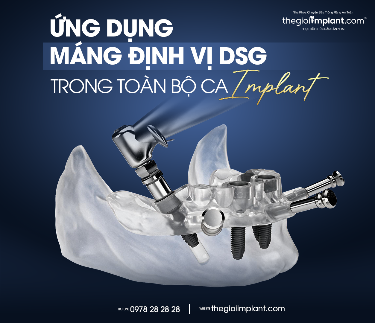implant jd - hình 4